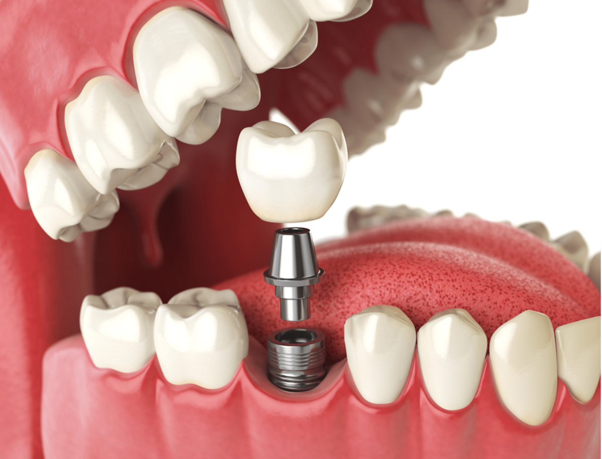 everything you need to know about dental implants
