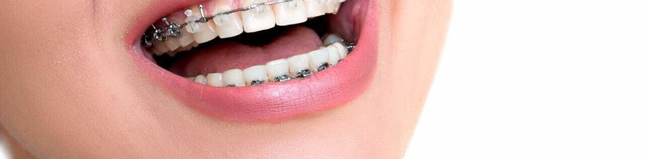 when do dental fillings need to be replaced?