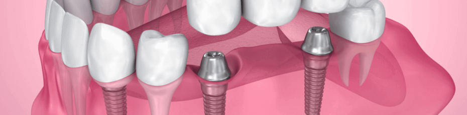 what you need to know about the dental implant procedure