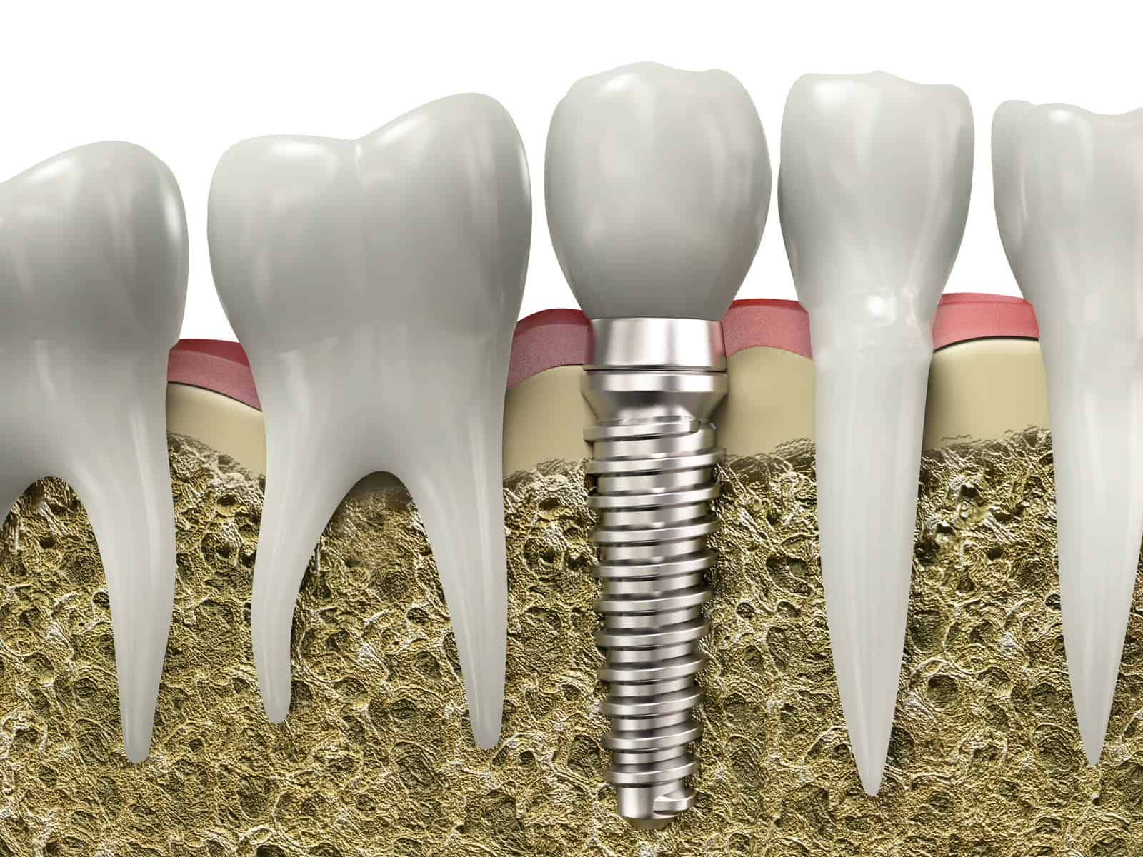 dental implants in davie