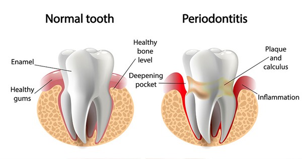 periodontal treatment in davie