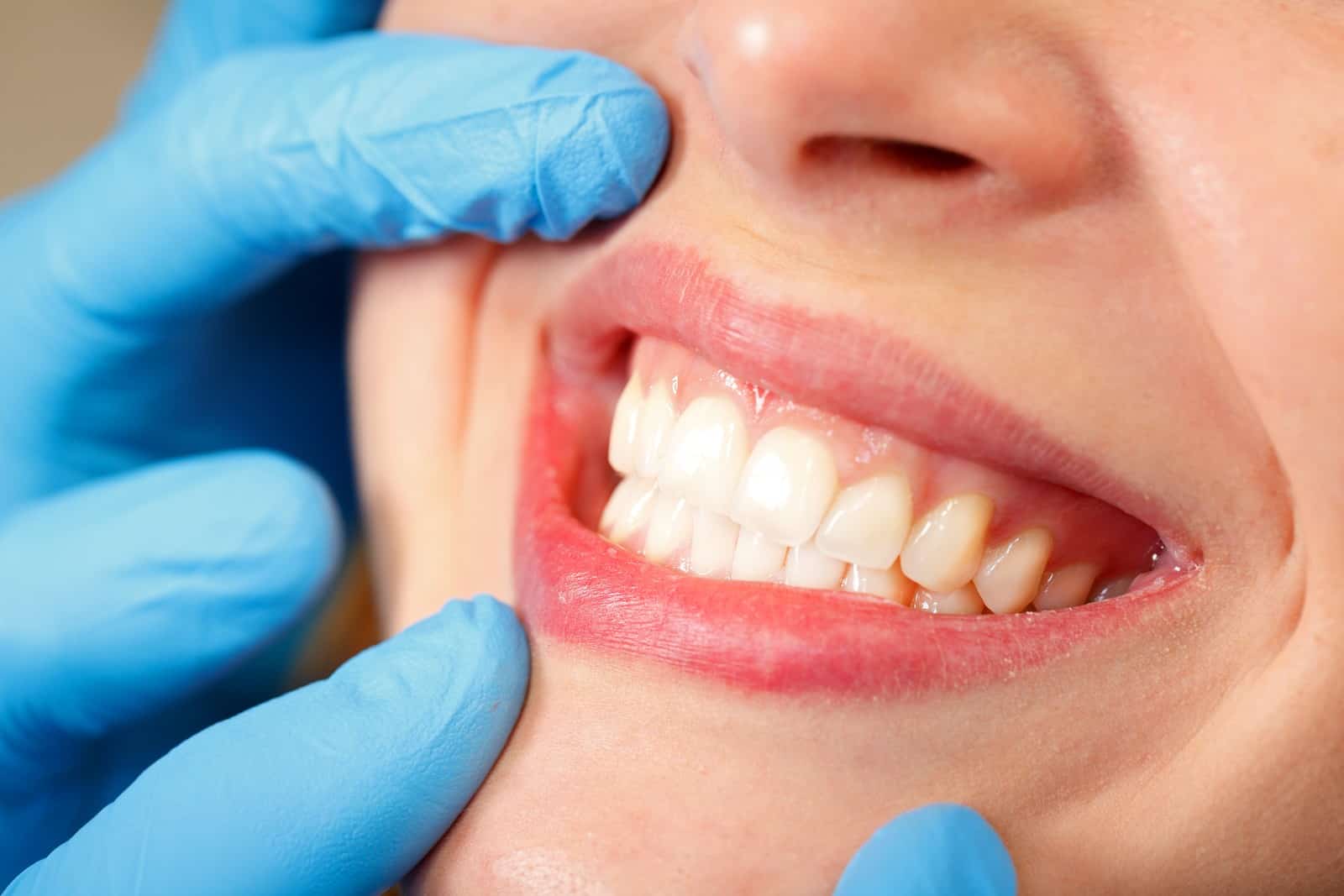 porcelain veneers in davie-Porcelain veneers