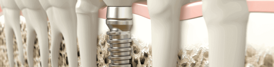 types of dental implants