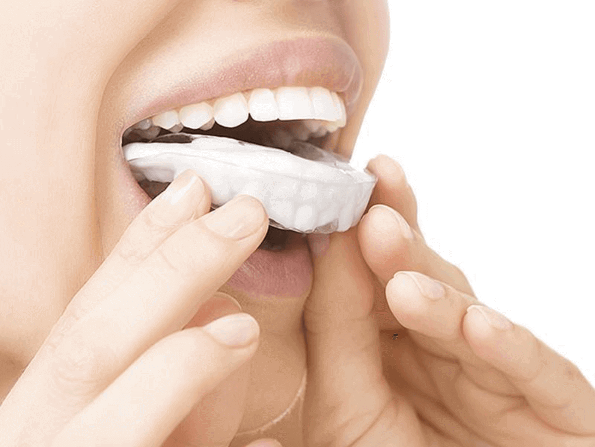 the straightforward guide to choosing the right mouthguard