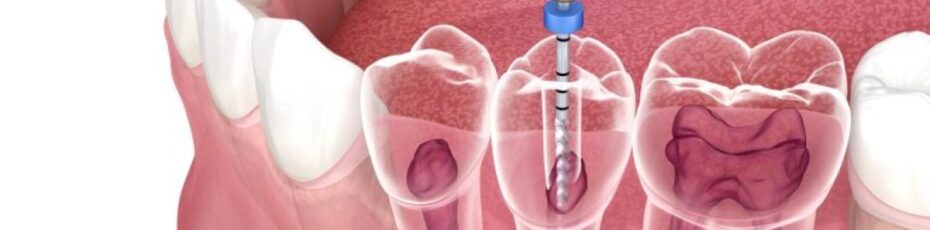 what are the benefits of root canal