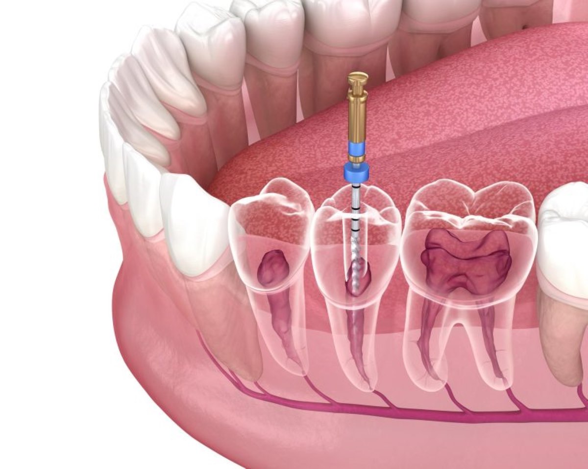 what are the benefits of root canal