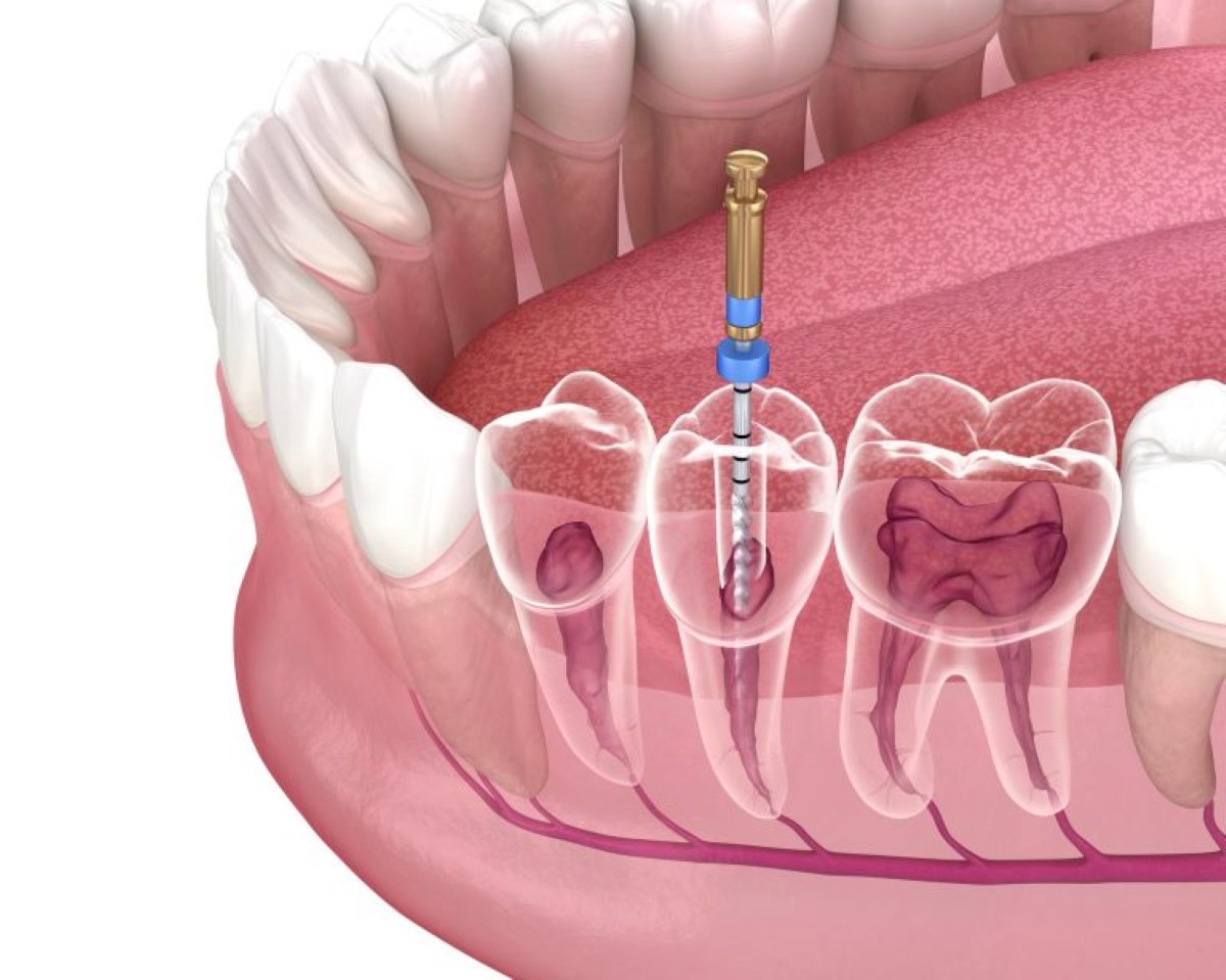 what are the benefits of root canal-Root Canal Therapy