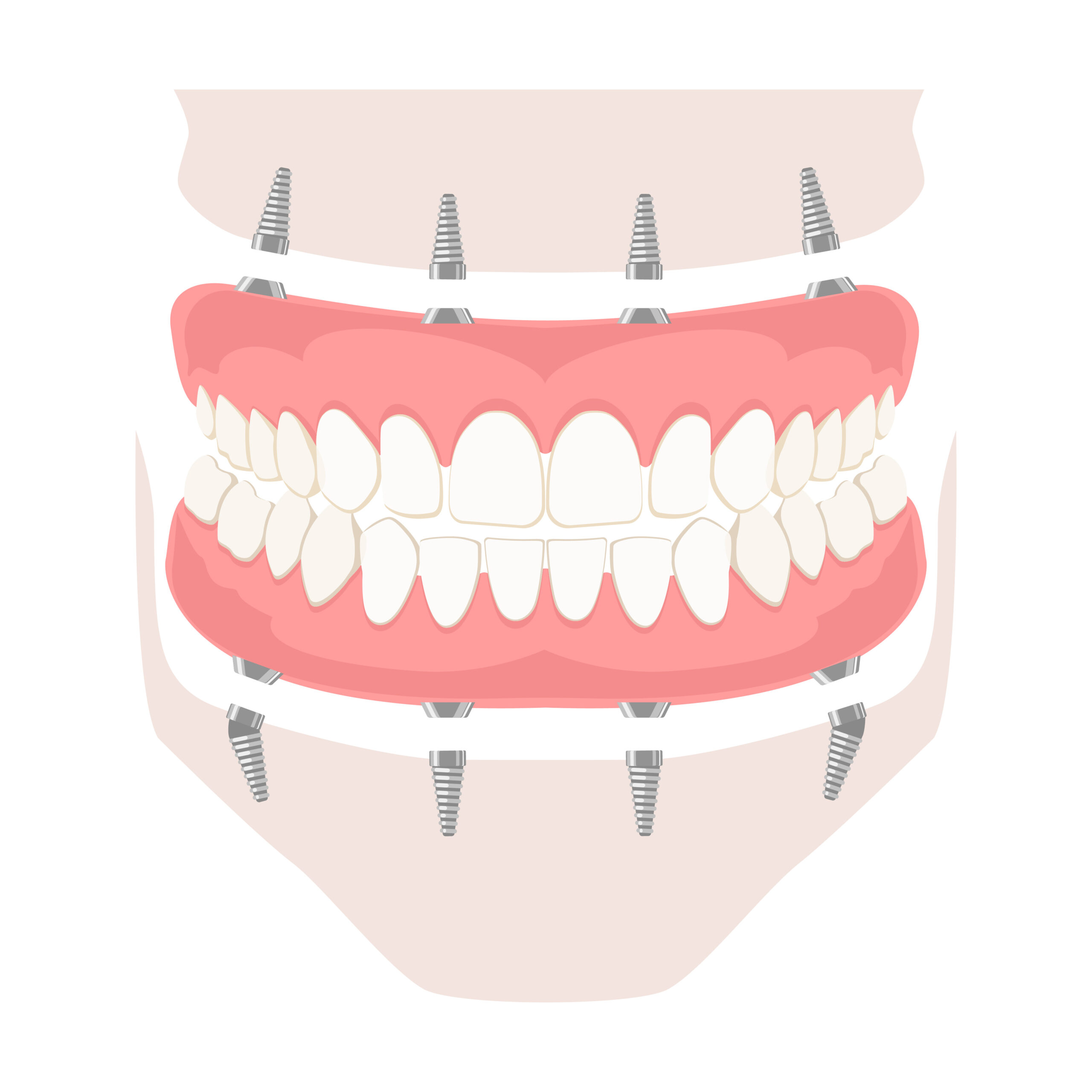 Dental implant specialist in Florida offering expert care