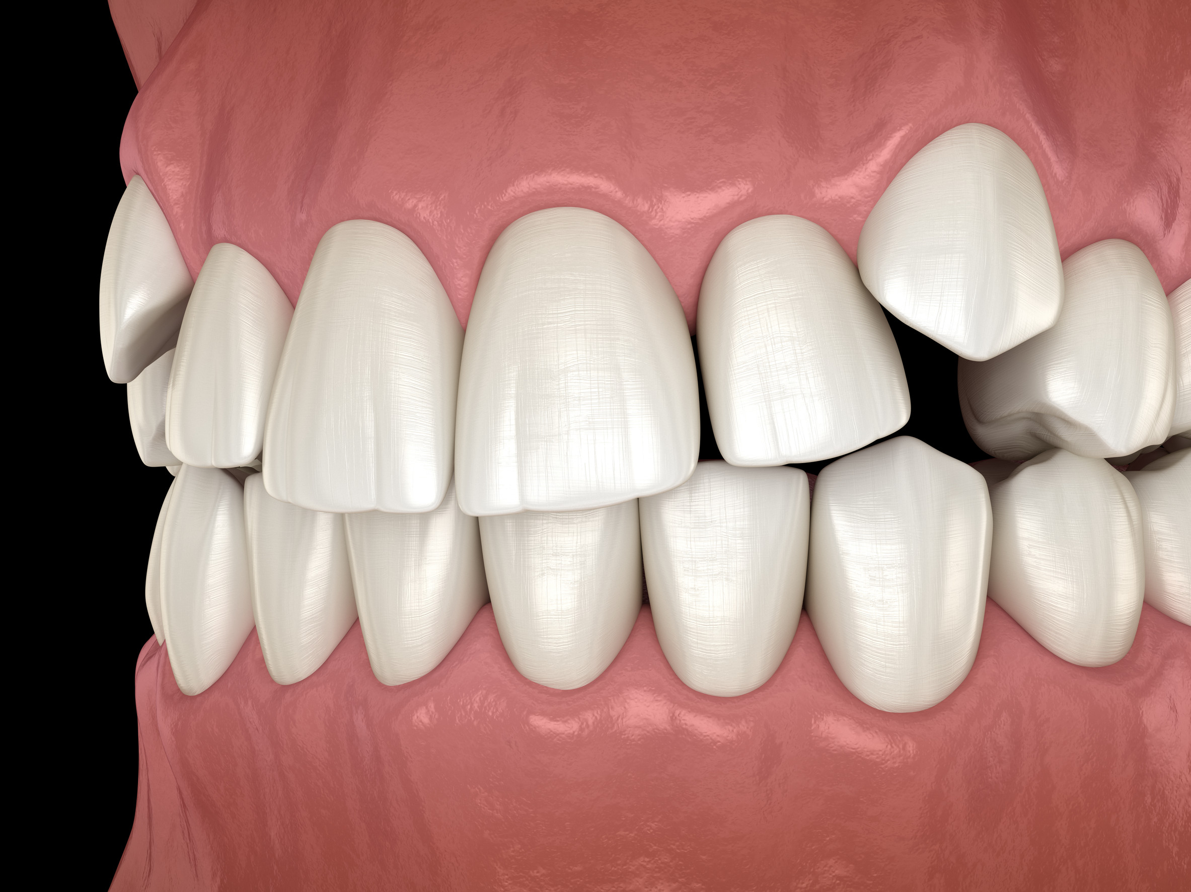 Impacted Teeth