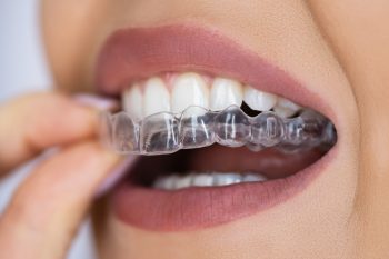 can i straighten my teeth without metal braces