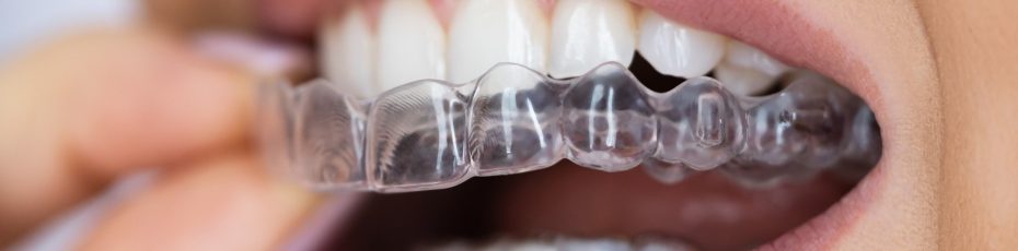 can i straighten my teeth without metal braces
