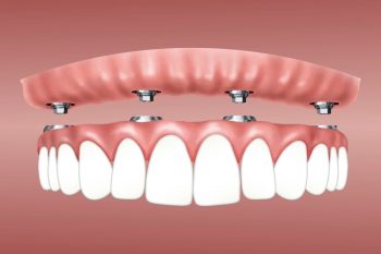 full mouth implants and how much do they cost