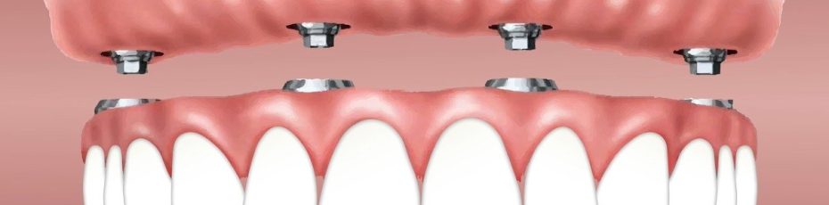 full mouth implants and how much do they cost