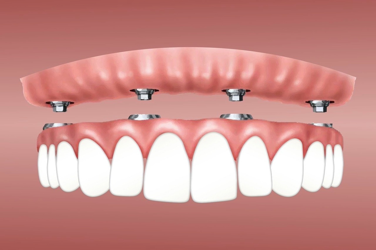 full mouth implants and how much do they cost
