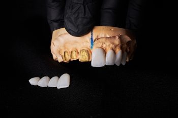 dental bonding for chipped or gapped teeth