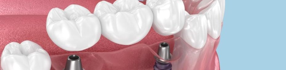 how long does the dental implant process take