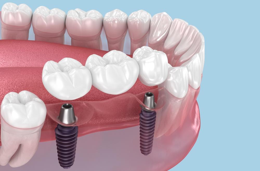 how long does the dental implant process take
