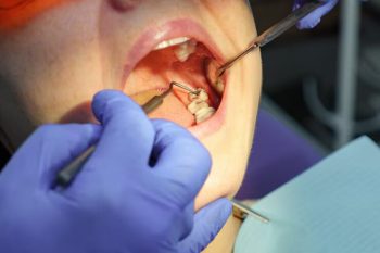 dentist performing tooth extraction