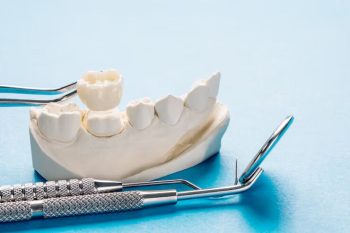 Dental bridge procedure illustration