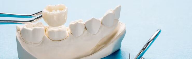 Dental bridge procedure illustration