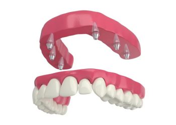All-on-4 dental implant treatment model