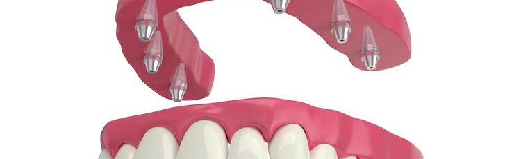 All-on-4 dental implant treatment model