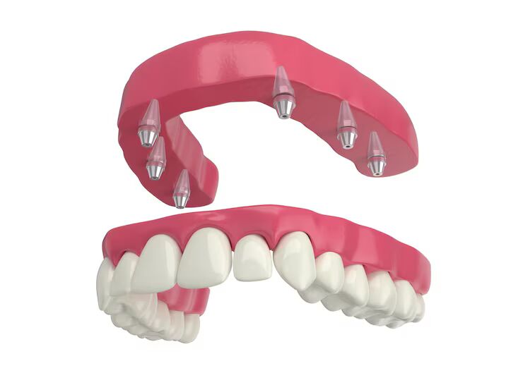 All-on-4 dental implant treatment model